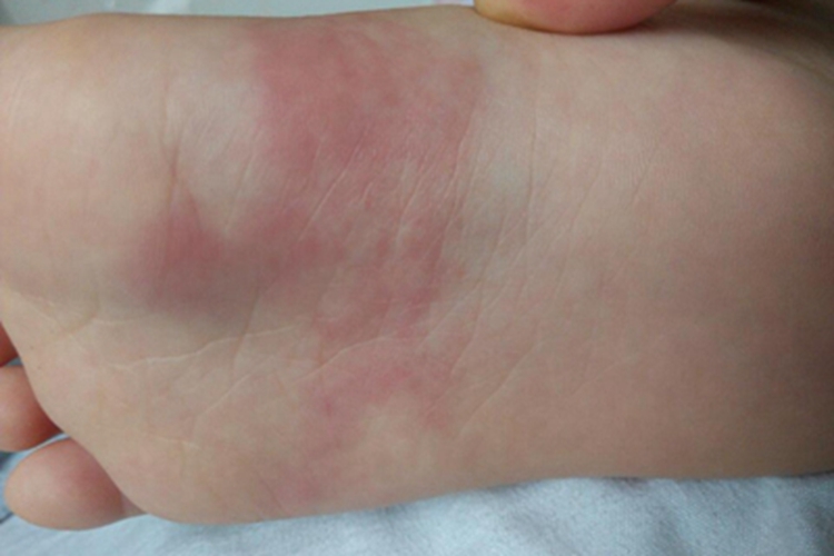 革螨皮炎脚底红斑图