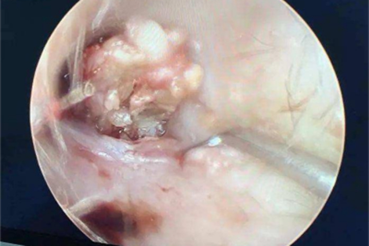 外耳道胆脂瘤外耳道瘤图