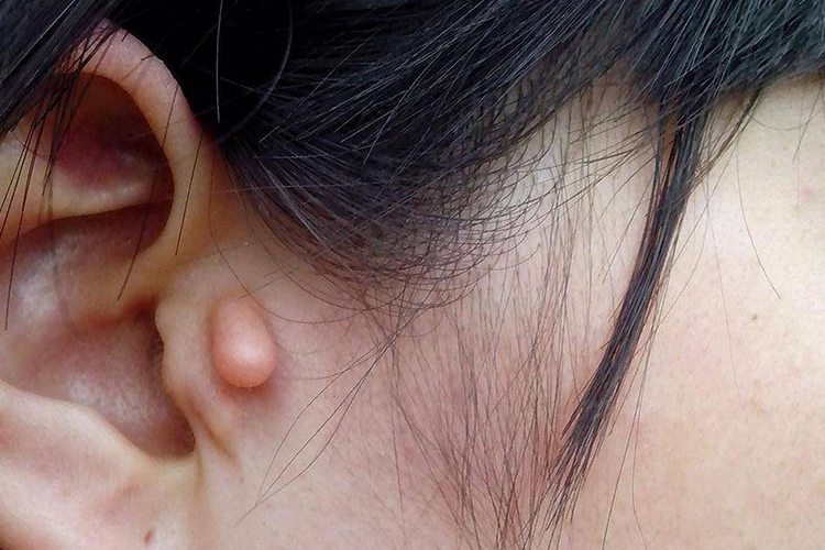 耳部副耳图 耳部副耳图