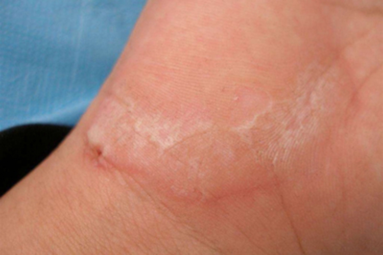 条纹状掌跖角化病手掌症状图