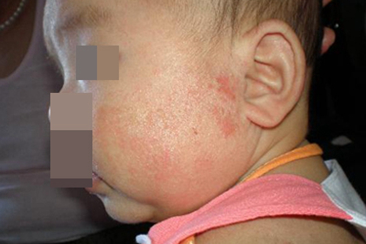 干性湿疹面部症状图