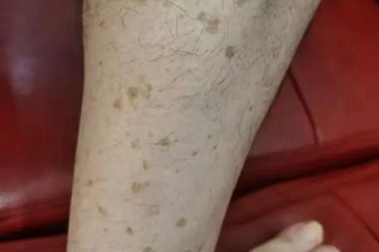 扁平疣小腿上密布褐色斑点图