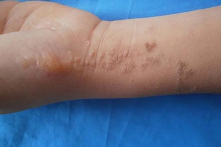 局限型表皮痣症状图