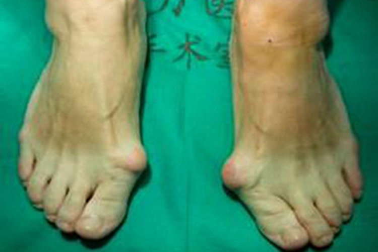 拇趾滑囊炎大包图 拇趾滑囊炎大包图