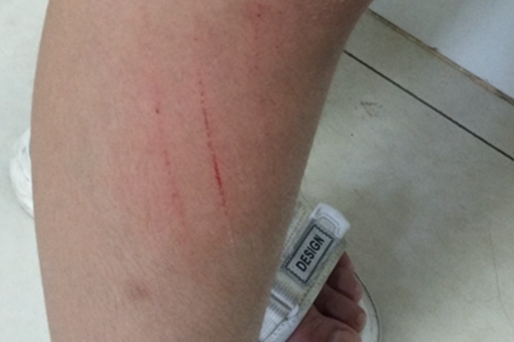 划伤小腿有细小的血丝图