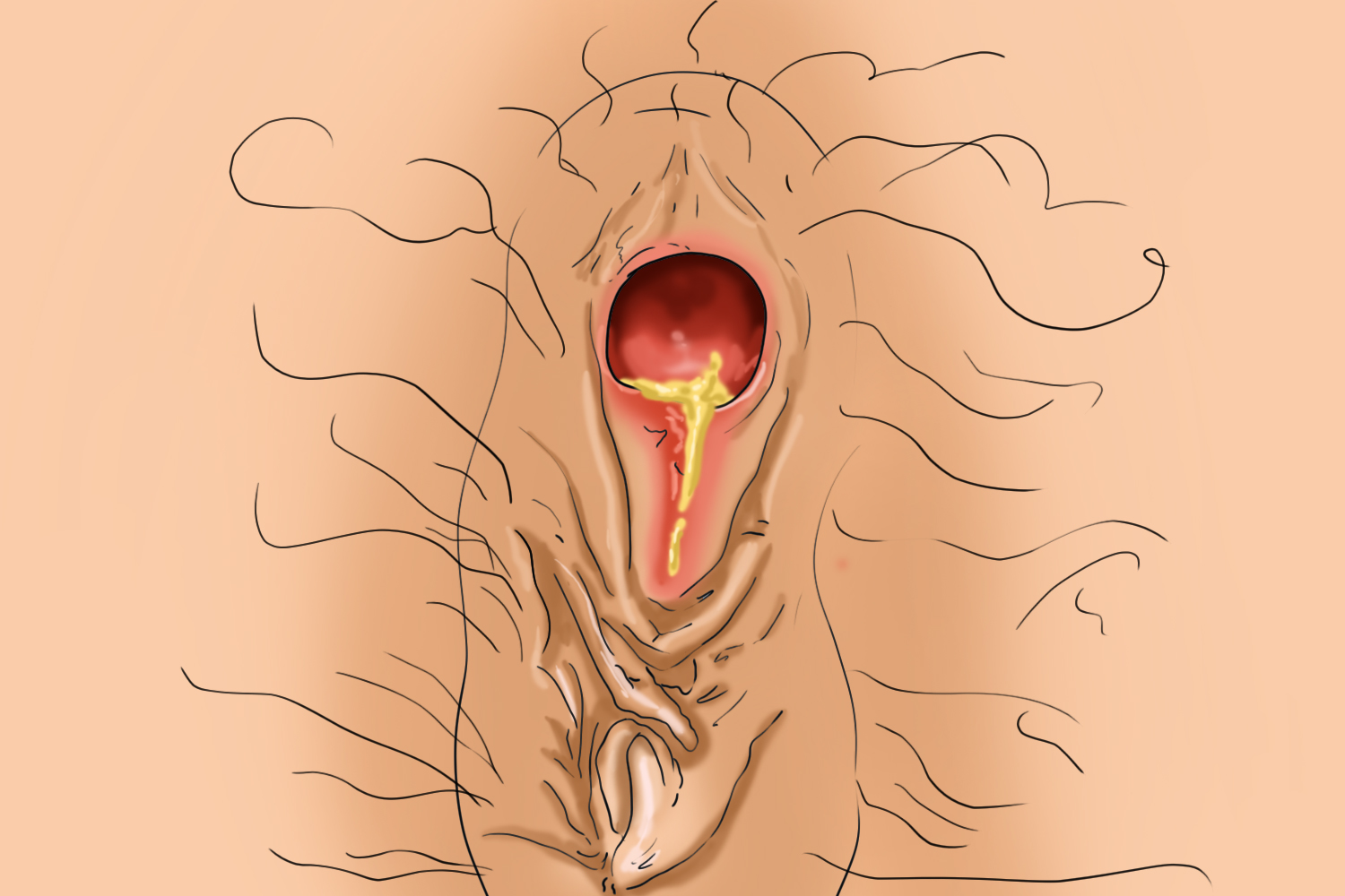 肛瘘流脓图 肛瘘流脓图