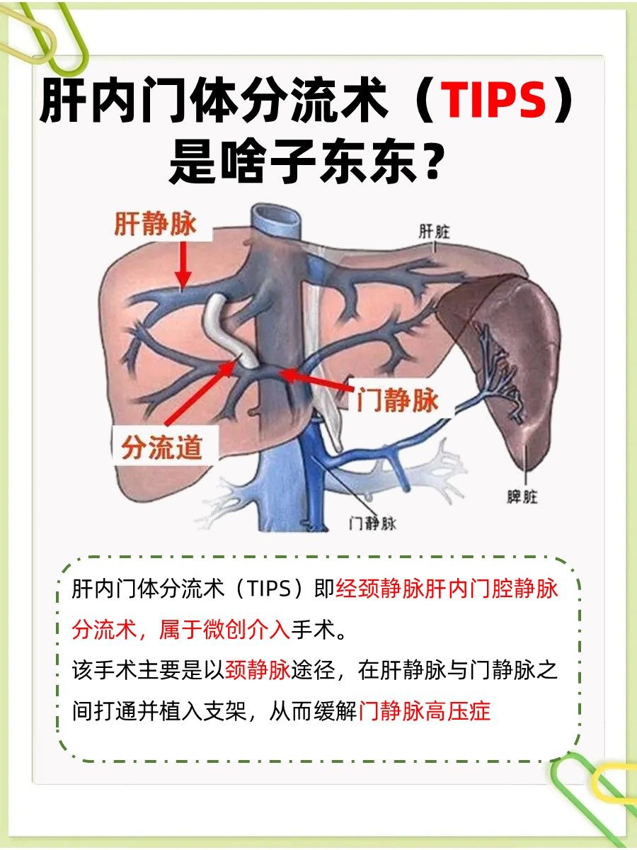 速戳！肝内门体分流术（TIPS）是什么意思？