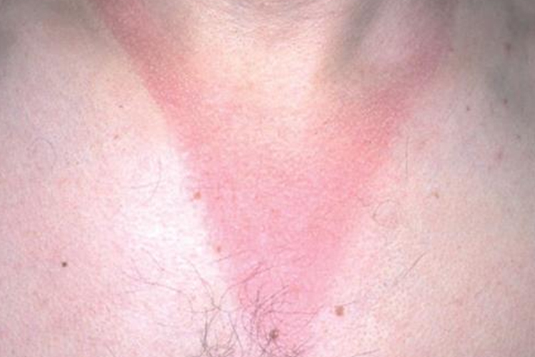 日光性荨麻疹图