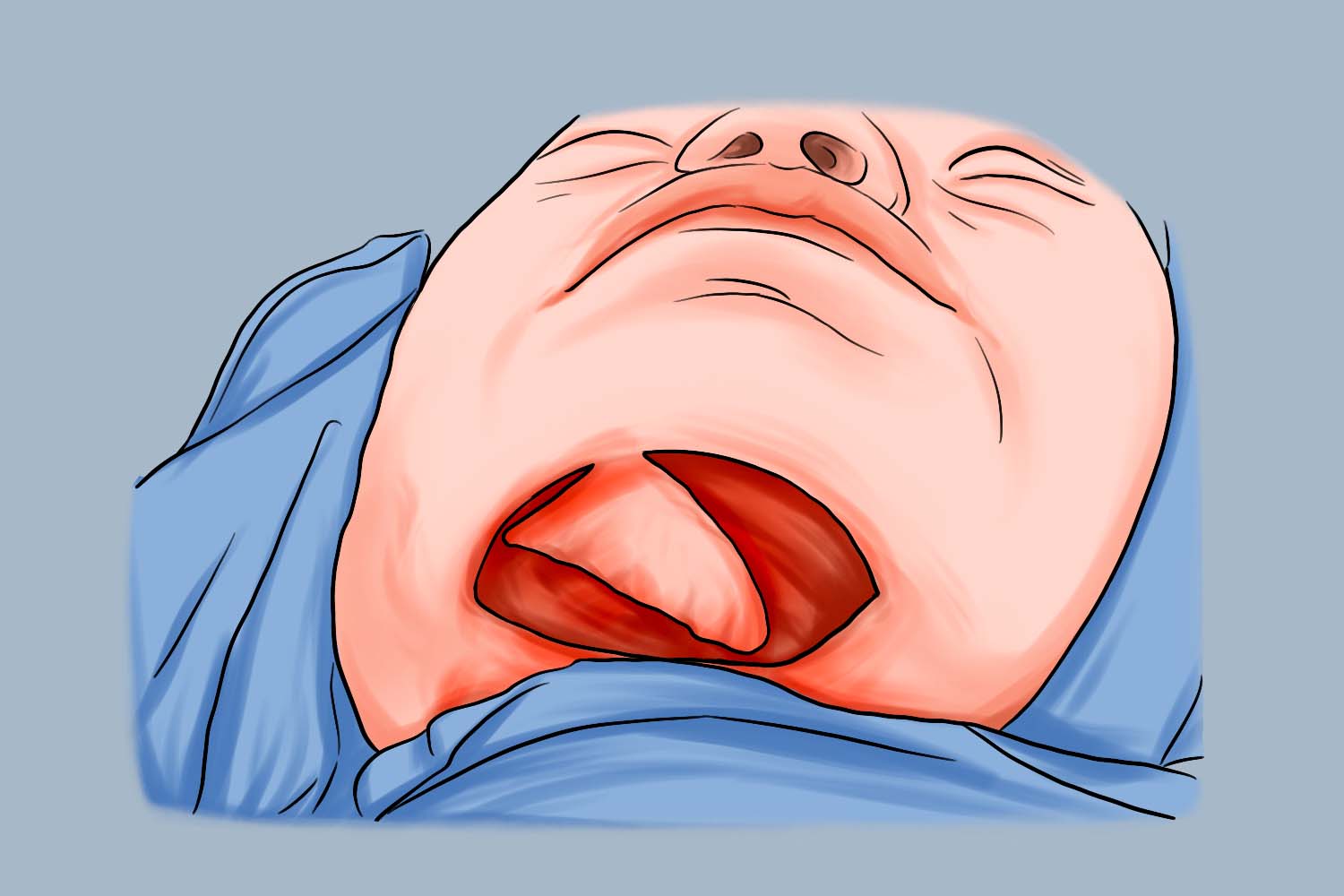 颏下岛状皮瓣取皮图 颏下岛状皮瓣取皮图