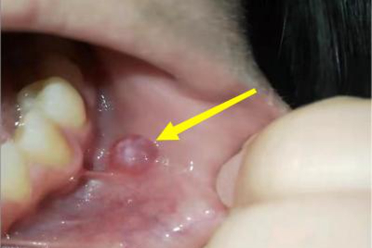 黏液腺囊肿小疙瘩图 黏液腺囊肿小疙瘩图