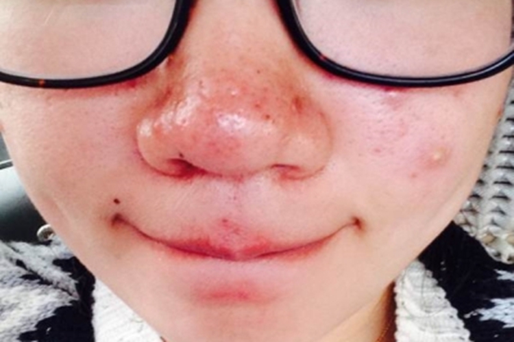 鼻赘型酒糟鼻鼻子长丘疹结痂图