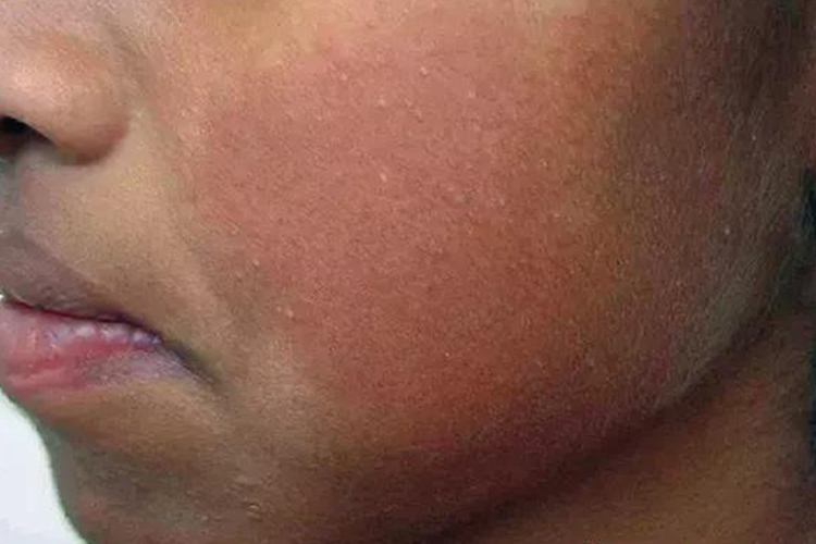 面部严重毛周角化病图 面部严重毛周角化病图