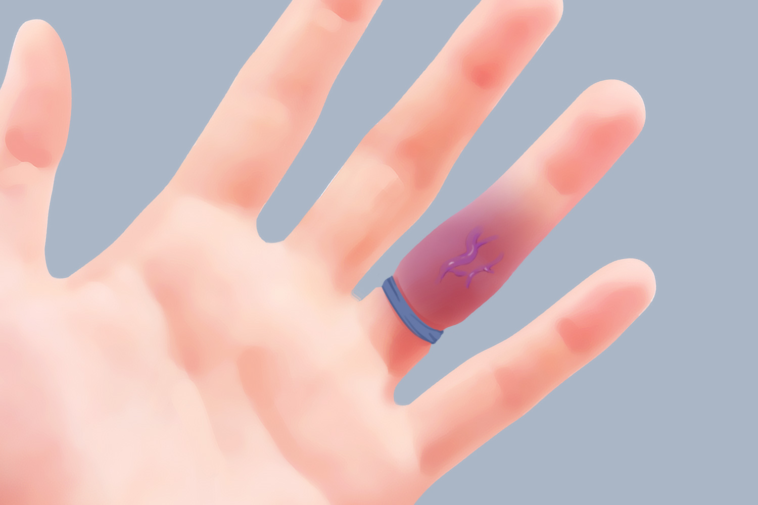 手指受压血管肿胀青紫图 手指受压血管肿胀青紫图