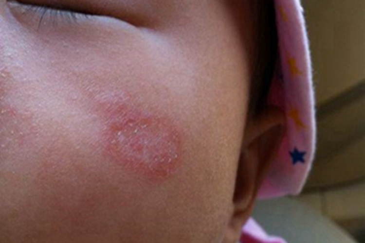 儿童银屑病面部症状图