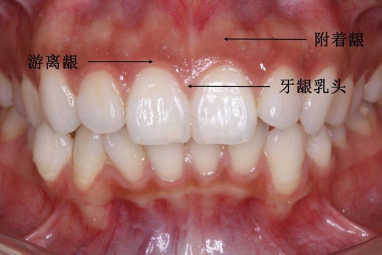 其侧缘和顶缘由相邻牙的游离龈延续而成,颊,舌侧面的中央部分由附着龈