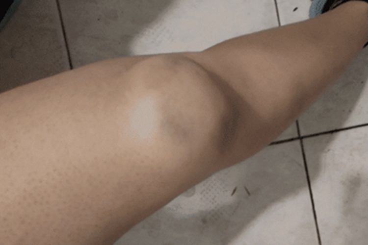 扭伤膝盖变肿图