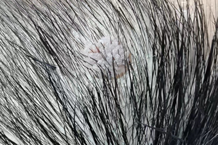 寻常疣头皮上有一块疙瘩图 寻常疣头皮上有一块疙瘩图