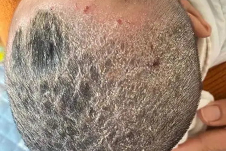 奶癣头皮上许多皮屑脱落图
