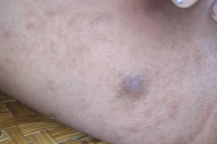 胯下寻常疣图 胯下寻常疣图