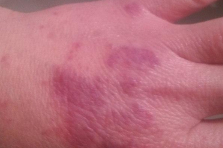 可变性红斑角化症手背症状图