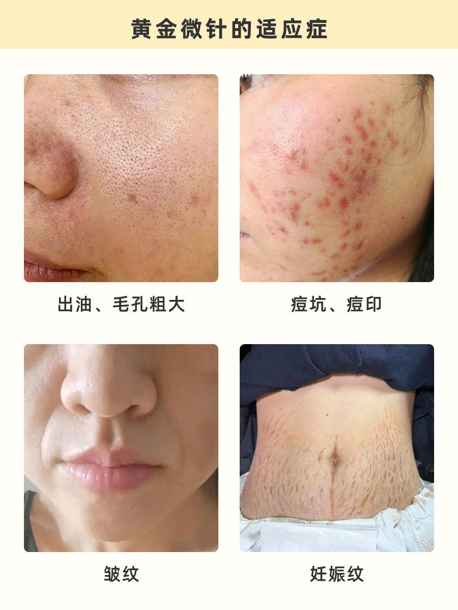 杭州黄金微针攻略：美肤界的“全能选手”！