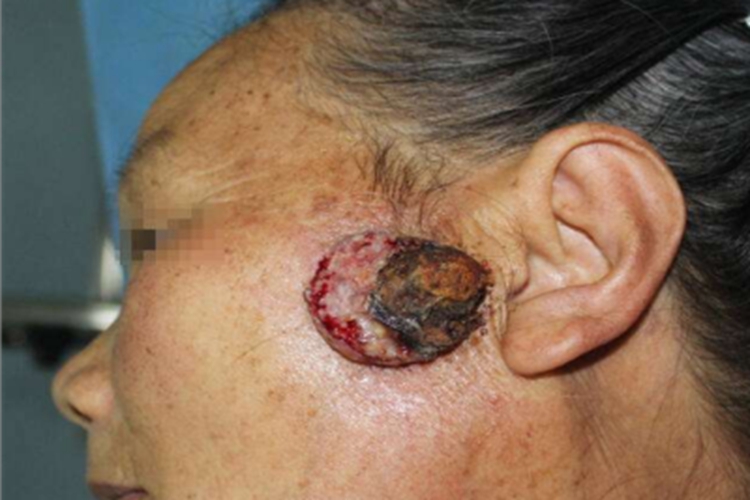 皮肤鳞状细胞癌面部肿块图