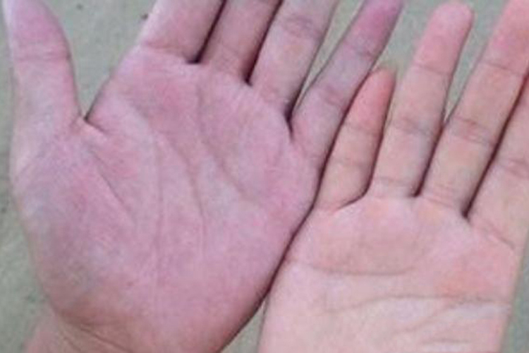 手掌发黑发紫图 手掌发黑发紫图