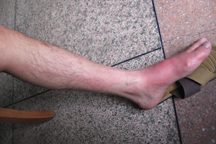 丝虫病脚部症状图