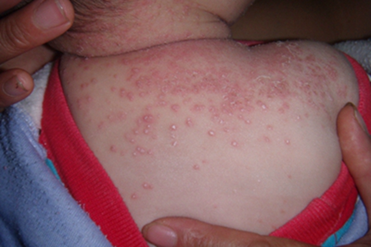 自体敏感性湿疹背部小红疙瘩图