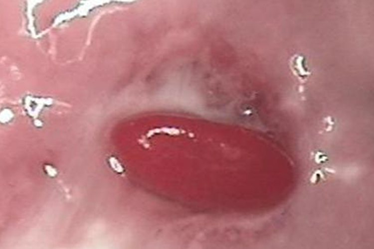 宫颈息肉呈舌头状图