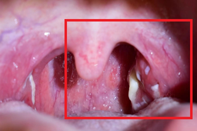 扁桃体炎脓肿图