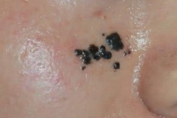 口腔颌面部恶性黑色素瘤症状图
