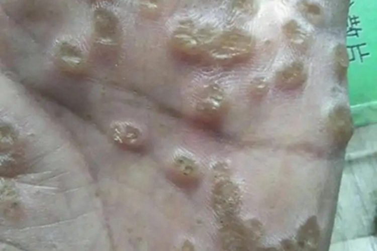 钱币状掌跖角化病疙瘩图