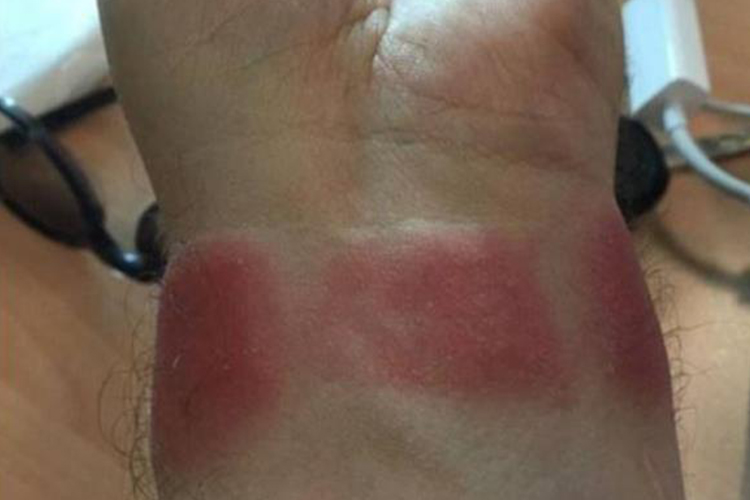 手腕接触性皮炎图