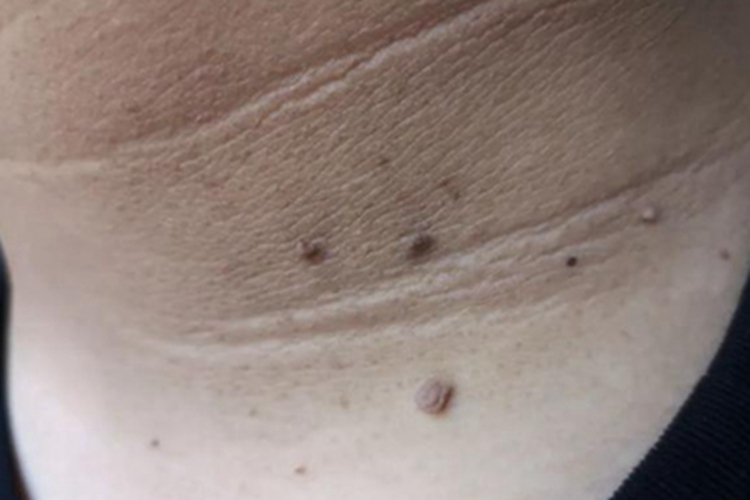 假性黑棘皮病颈部疙瘩图