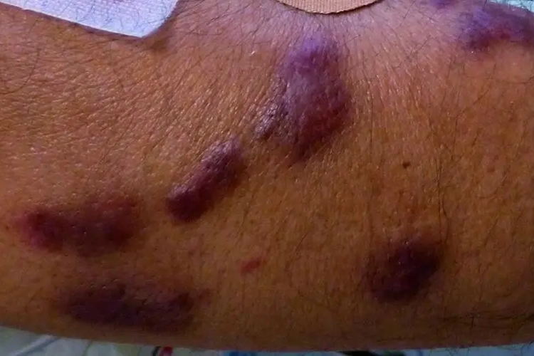 卡波西肉瘤初期皮损图
