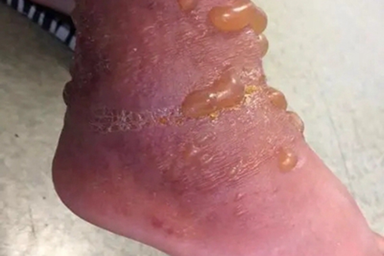 接触性皮炎脚踝红肿图