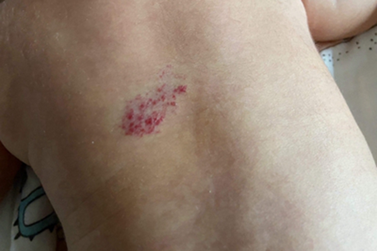 小儿血管瘤后背红色点状斑块图