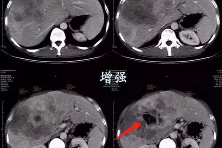黑色素瘤晚期肝转移CT图