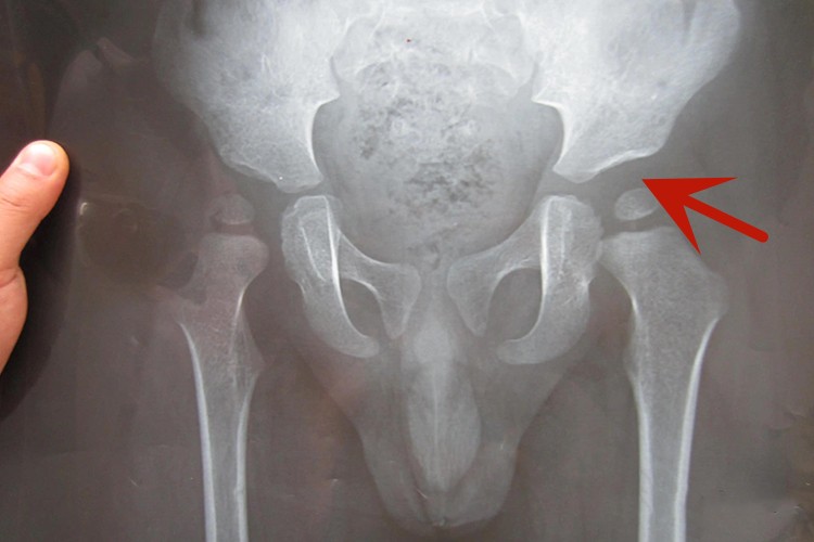 先髋宝宝X线图