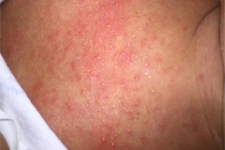 急性湿疹水疱图 急性湿疹水疱图