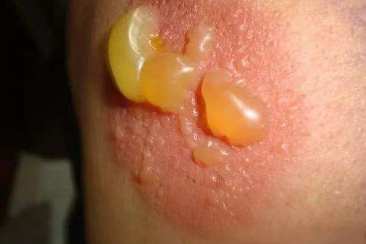 三伏贴起水疱图