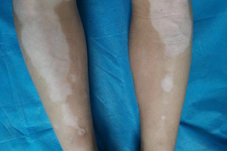 非节段型白癜风小腿白斑图