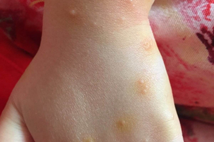 痒疹手部症状图