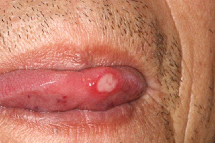 轻型复发性阿弗他口腔炎症状图 轻型复发性阿弗他口腔炎症状图