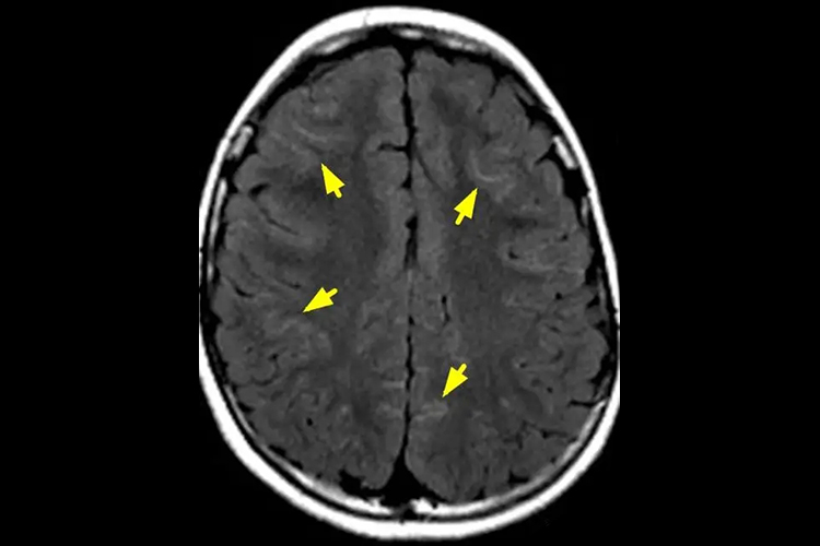 蛛网膜下腔出血MRI图 蛛网膜下腔出血MRI图