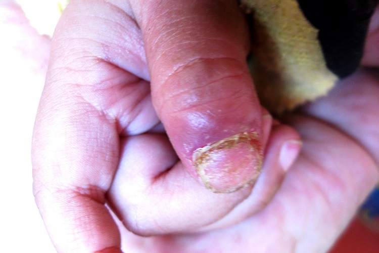 慢性化脓性甲沟炎手指甲红肿图