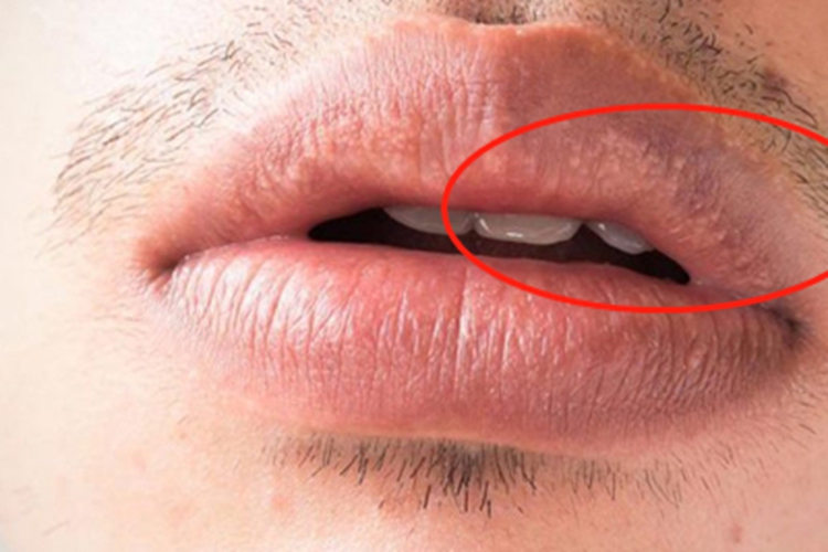 皮脂腺异位症嘴唇白点图