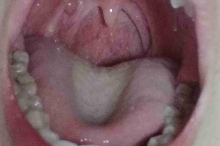 儿童咽喉无发红症状图 儿童咽喉无发红症状图