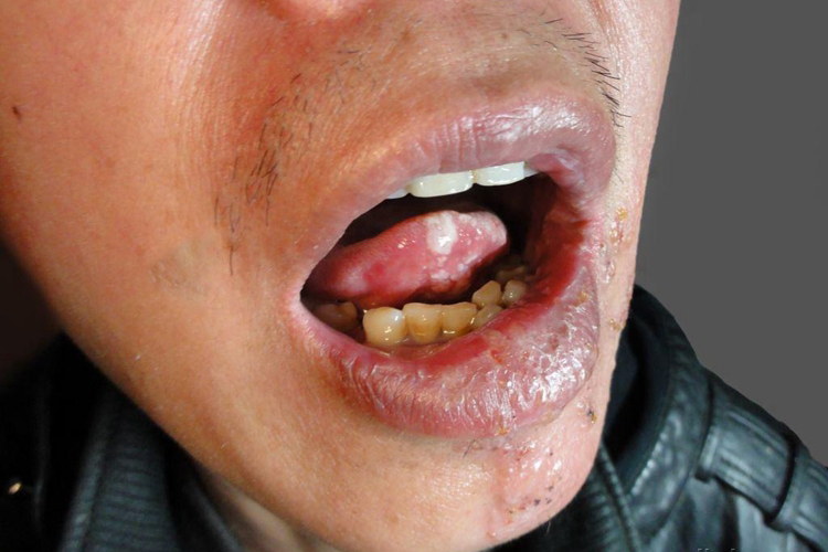 口腔带状疱疹舌头图